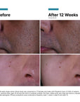 SkinCeuticals P-TIOX Cream Resultater