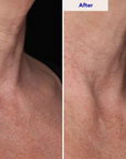 ZO Skin Health Neck Complex Before and After