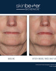 Skinbetter Interfuse Face and Neck resultater
