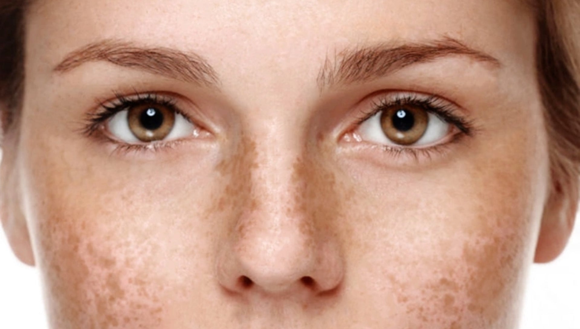 Hvordan unngå pigmentering og solskadet hud