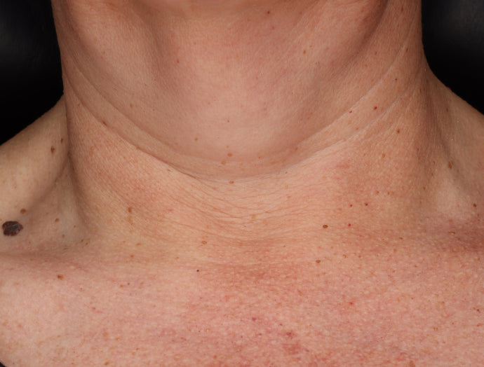 zo neck complex etter bilde