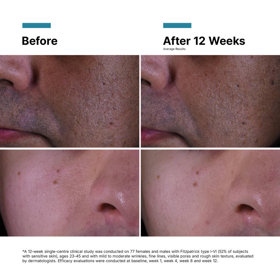 SkinCeuticals P-TIOX Cream Resultater