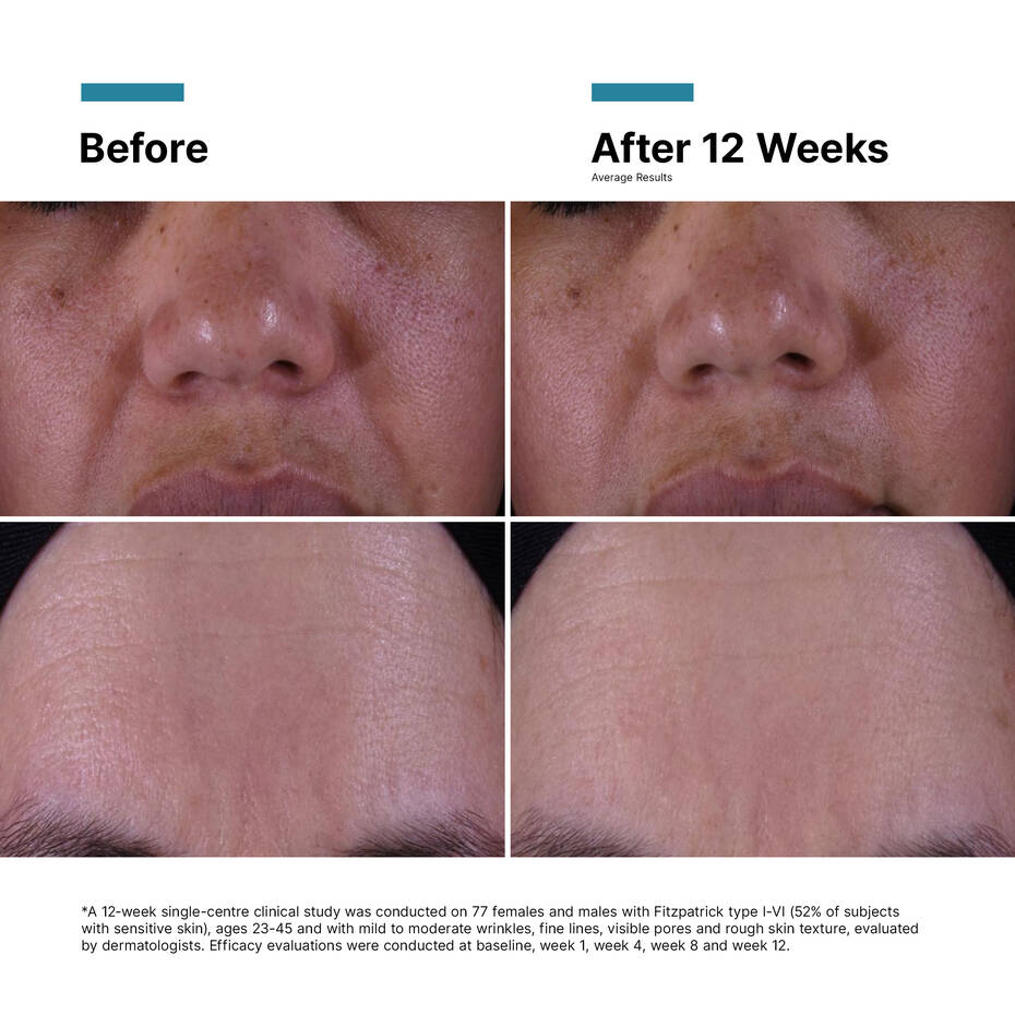SkinCeuticals P-TIOX Cream før og etter