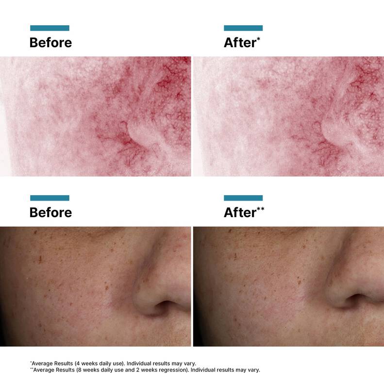SkinCeuticals Phyto Corrective PDRN Serum Before and After
