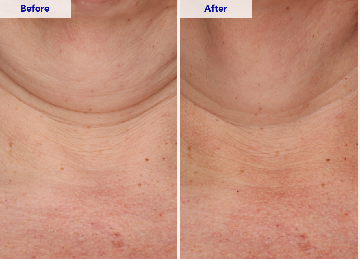 ZO Neck Complex Before and After
