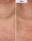 ZO Neck Complex Before and After