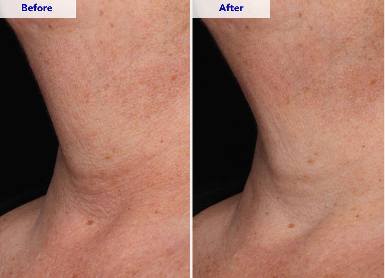 ZO Neck Complex Resultat