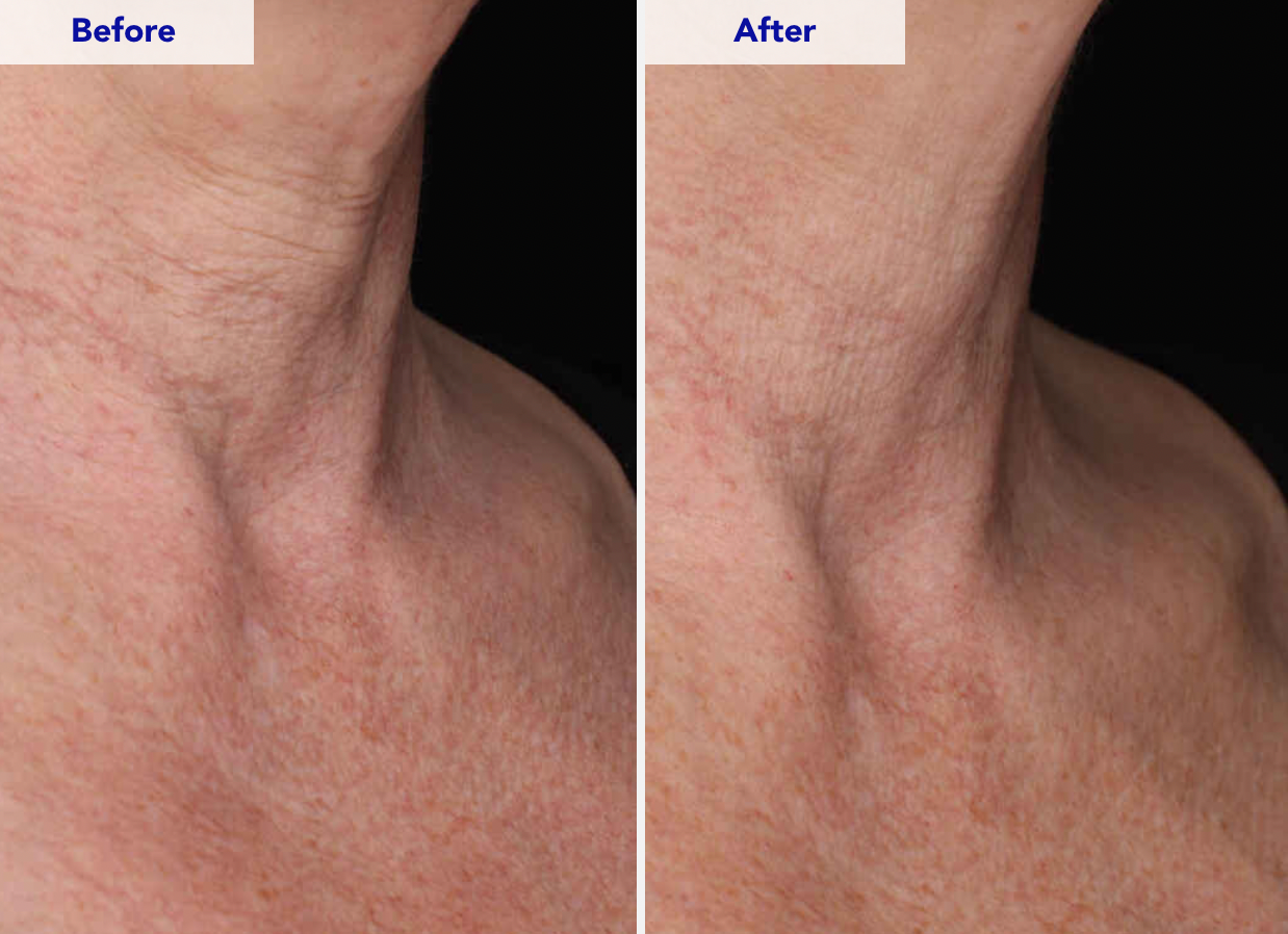 ZO Skin Health Neck Complex Before and After