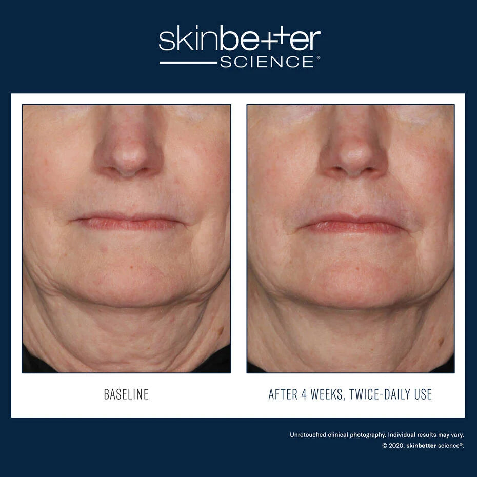 Skinbetter Interfuse Face and Neck resultater