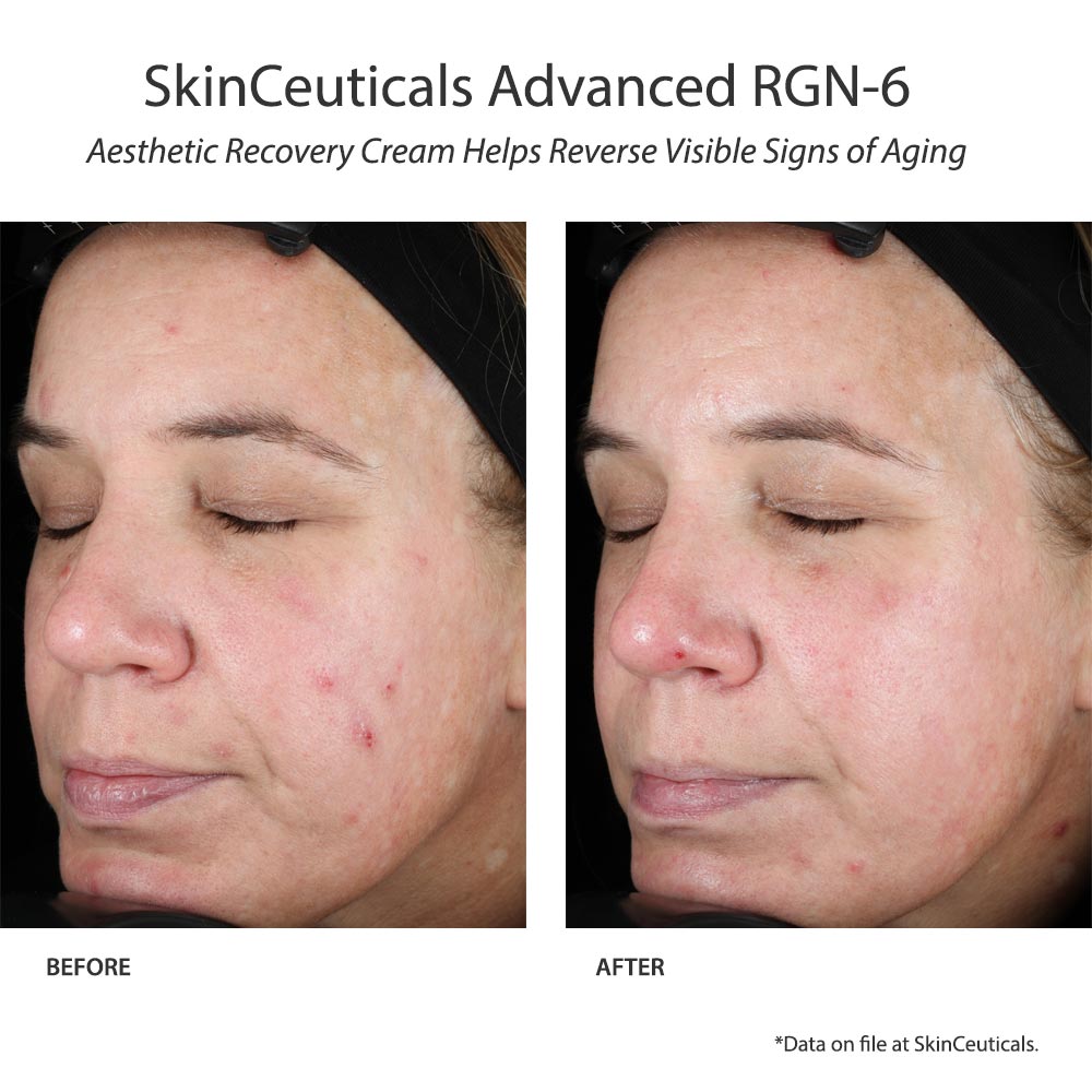 skinceuticals Advanced RGN-6 resultat