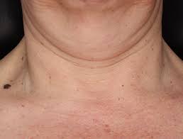 zo neck complex før bilde